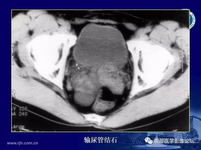 【PPT】急腹症