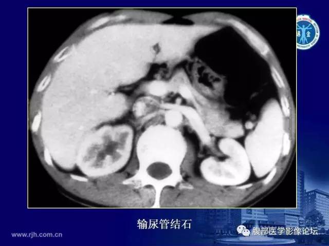 【PPT】急腹症