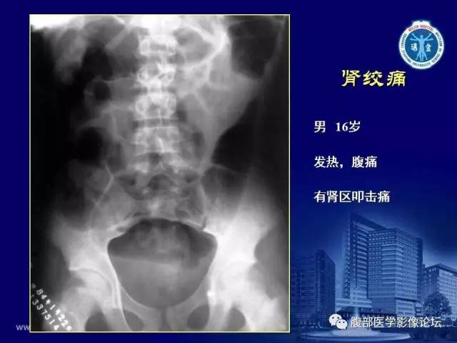 【PPT】急腹症