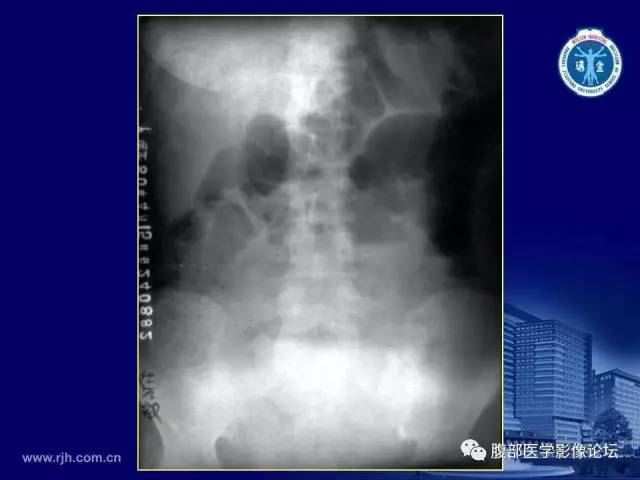 【PPT】急腹症
