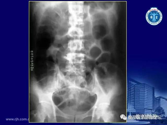 【PPT】急腹症