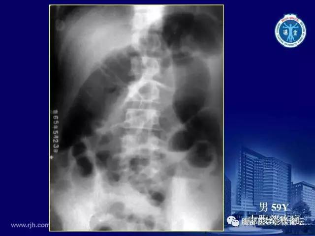 【PPT】急腹症