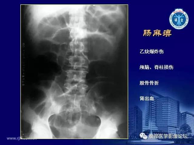 【PPT】急腹症