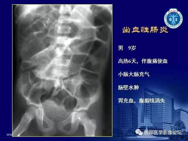 【PPT】急腹症
