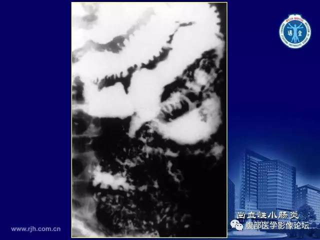 【PPT】急腹症