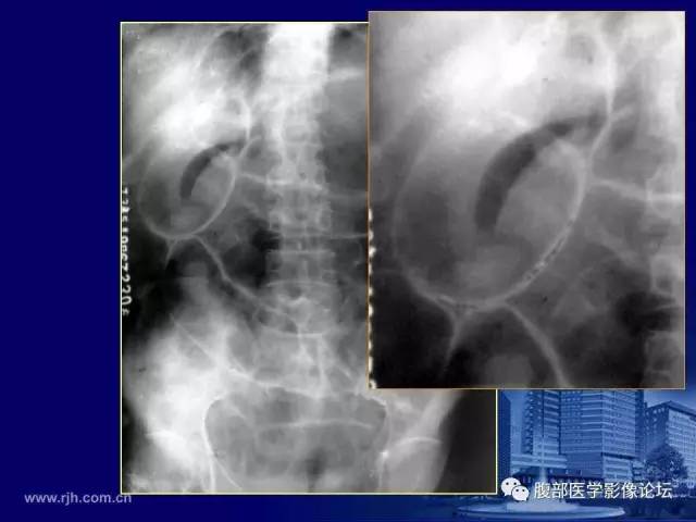 【PPT】急腹症