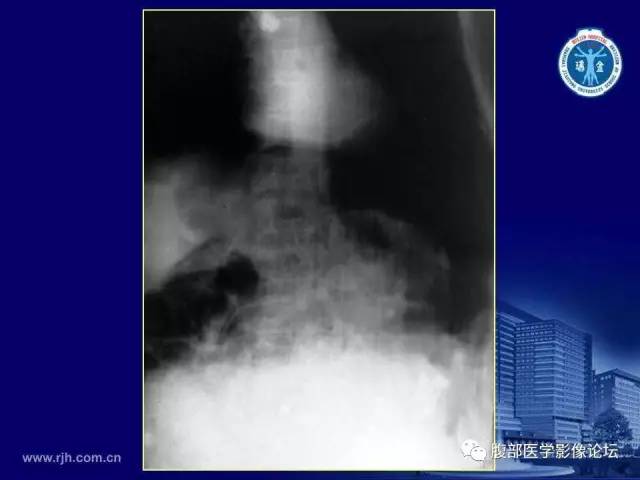 【PPT】急腹症