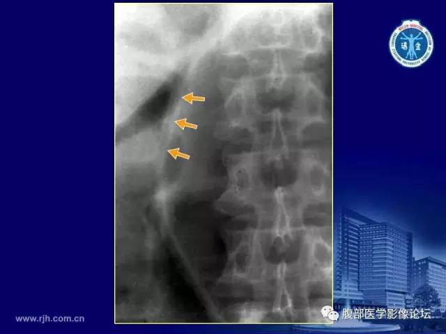 【PPT】急腹症