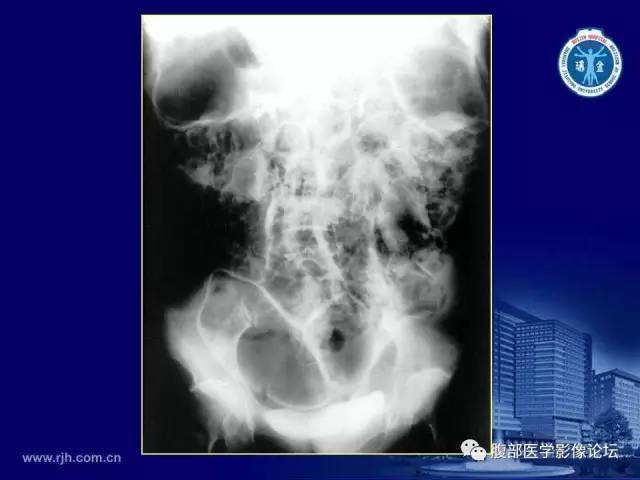 【PPT】急腹症