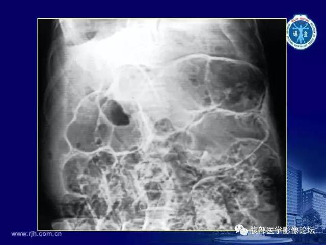 【PPT】急腹症
