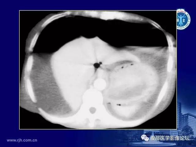 【PPT】急腹症