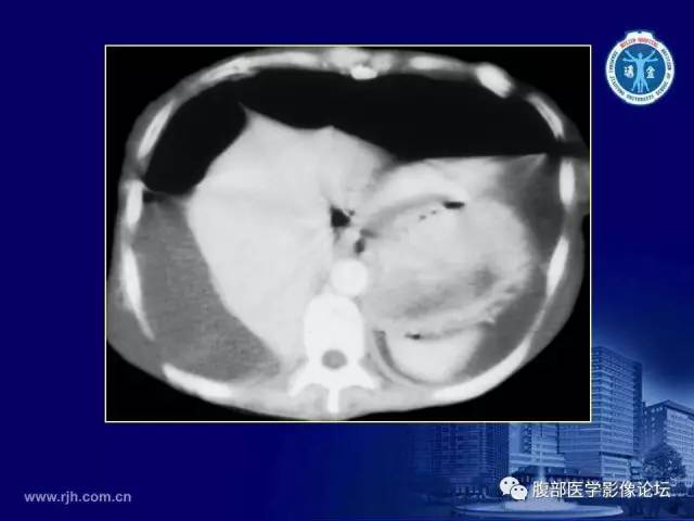 【PPT】急腹症
