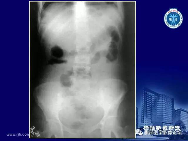 【PPT】急腹症