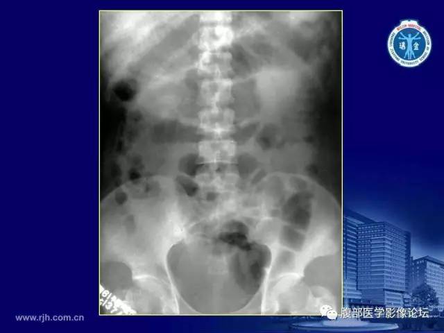 【PPT】急腹症
