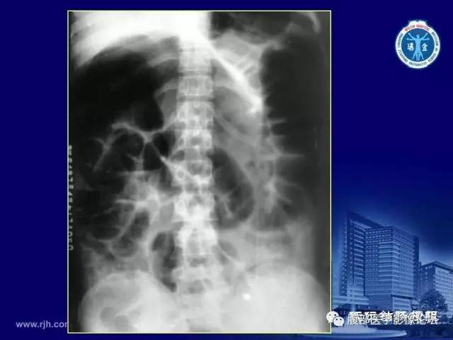【PPT】急腹症