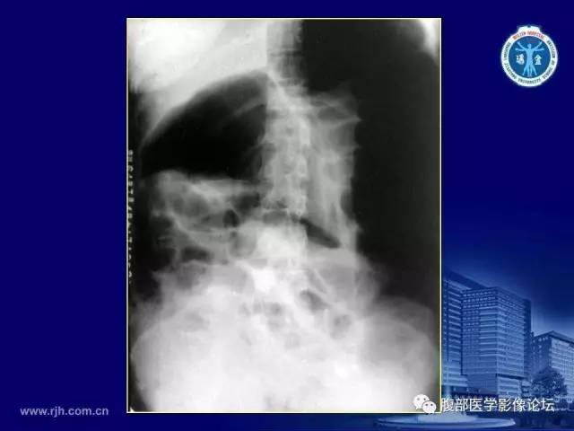 【PPT】急腹症