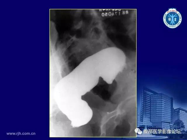 【PPT】急腹症