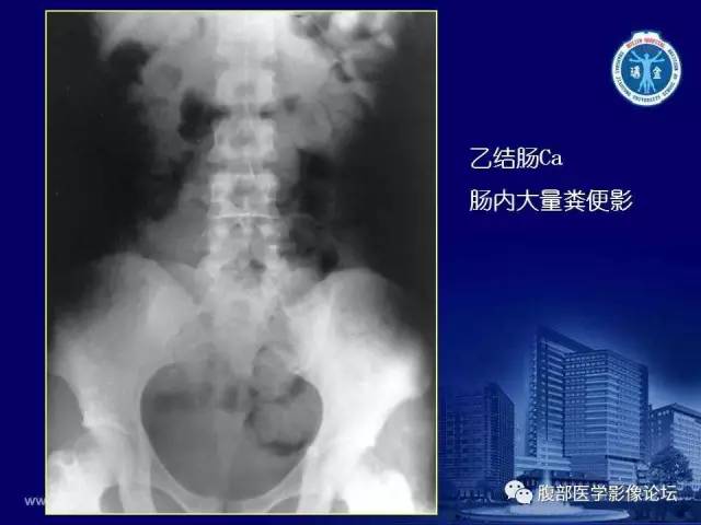 【PPT】急腹症