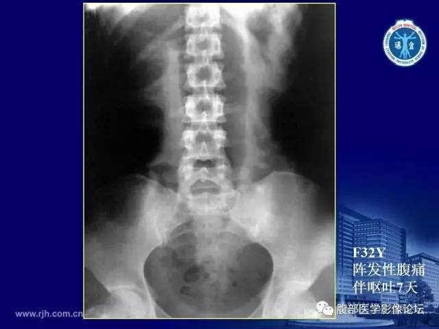 【PPT】急腹症