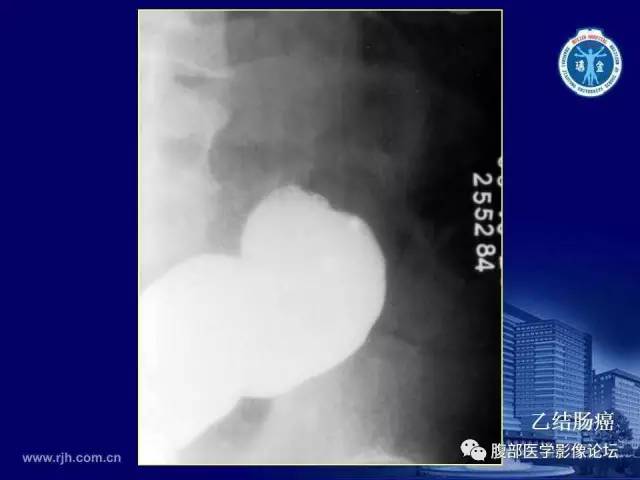 【PPT】急腹症