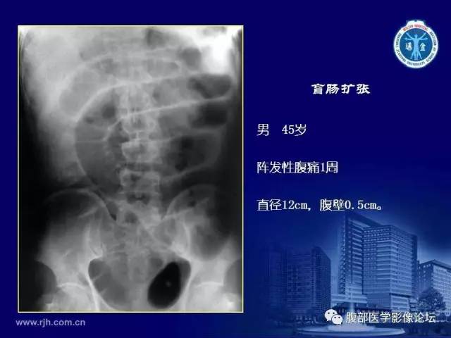 【PPT】急腹症