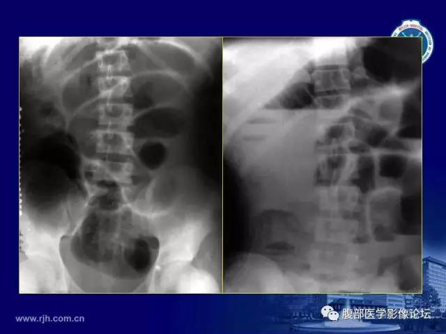 【PPT】急腹症