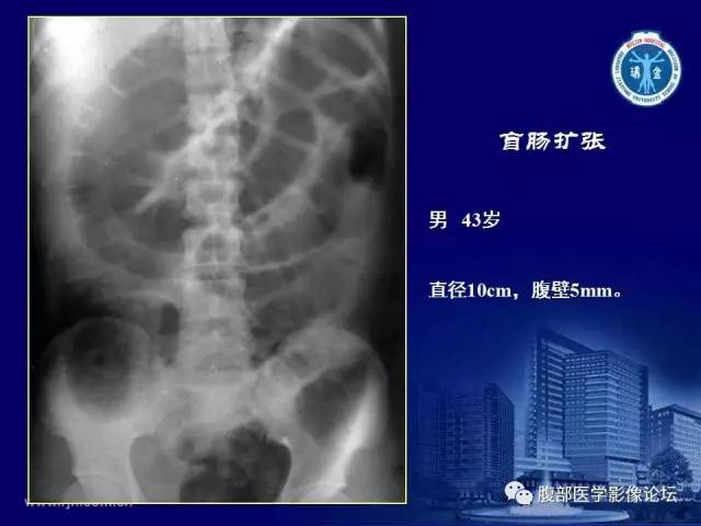 【PPT】急腹症