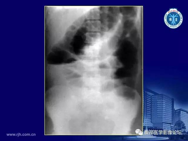 【PPT】急腹症