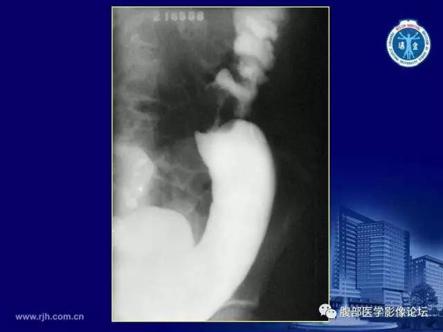 【PPT】急腹症
