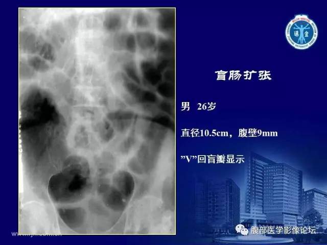 【PPT】急腹症