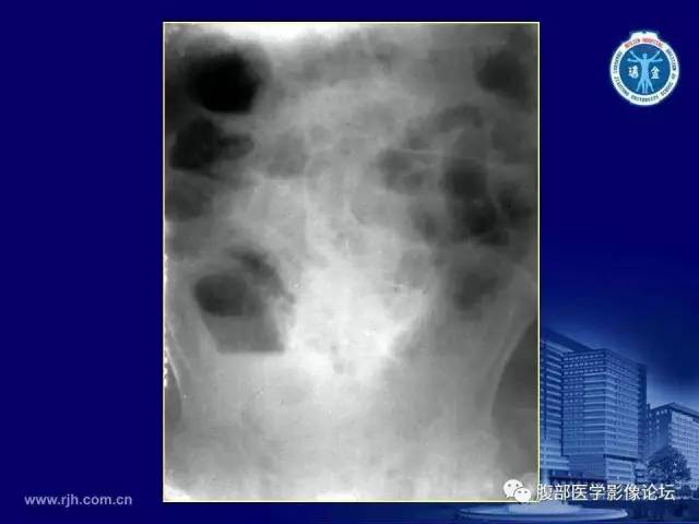 【PPT】急腹症