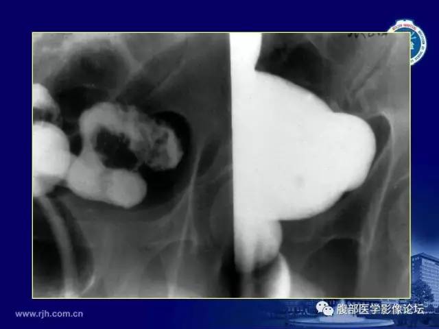 【PPT】急腹症
