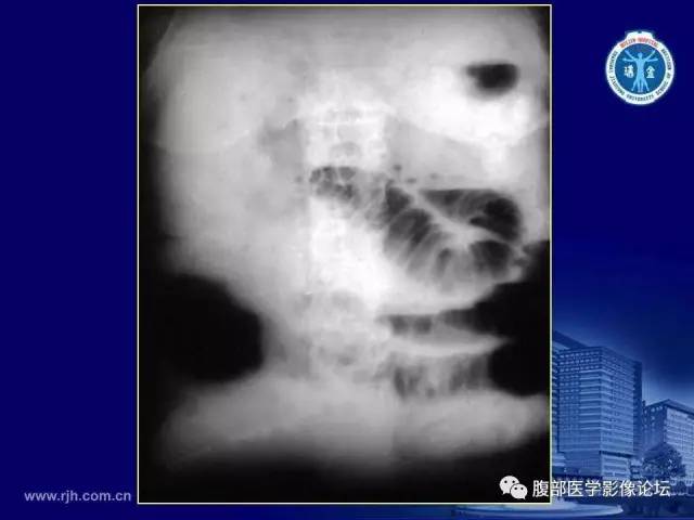 【PPT】急腹症