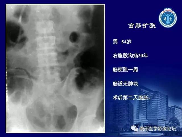 【PPT】急腹症