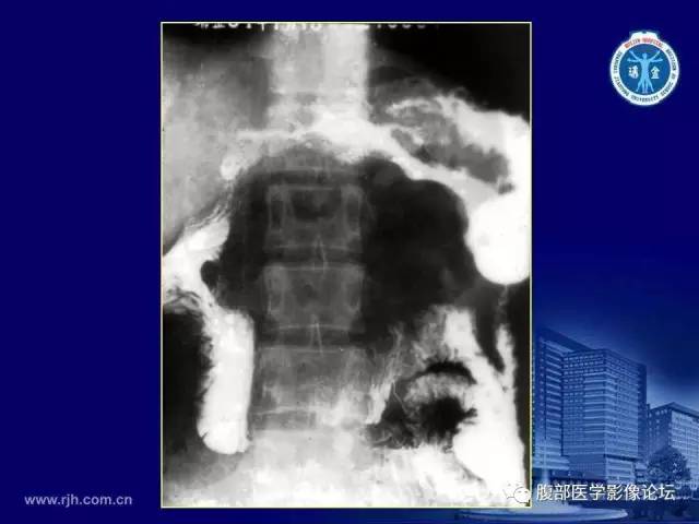 【PPT】急腹症