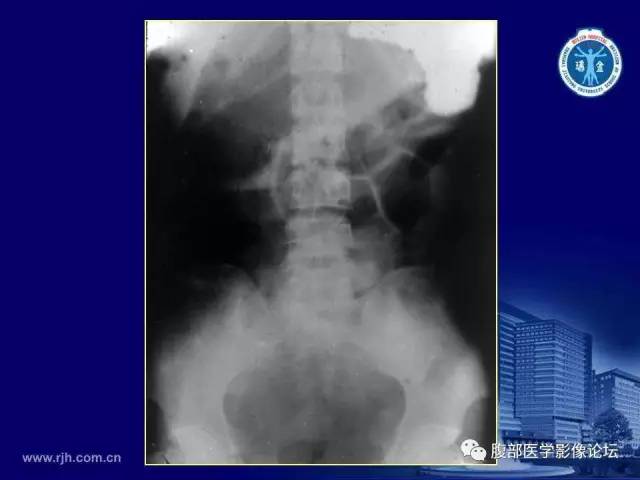 【PPT】急腹症