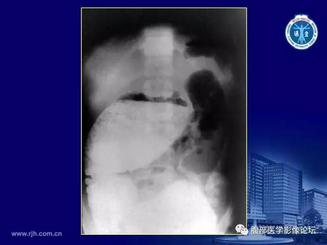 【PPT】急腹症