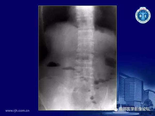 【PPT】急腹症
