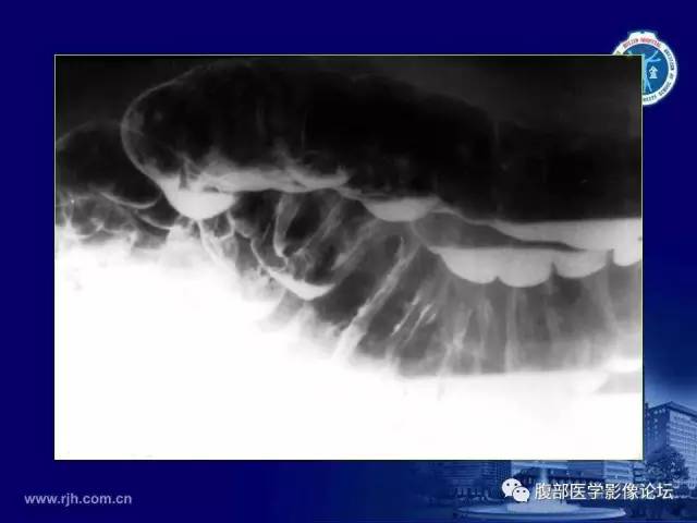 【PPT】急腹症