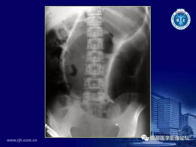 【PPT】急腹症