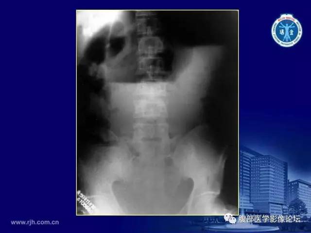 【PPT】急腹症