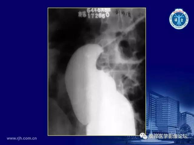 【PPT】急腹症