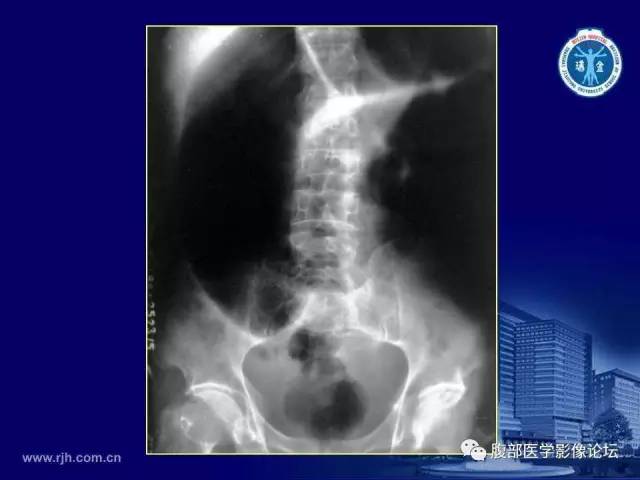 【PPT】急腹症