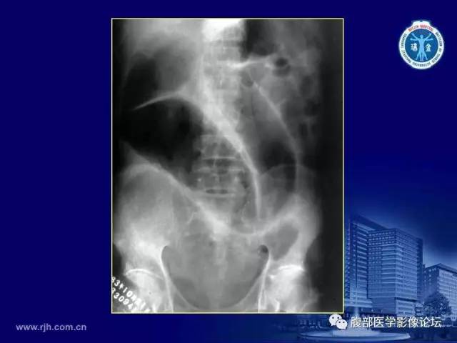 【PPT】急腹症