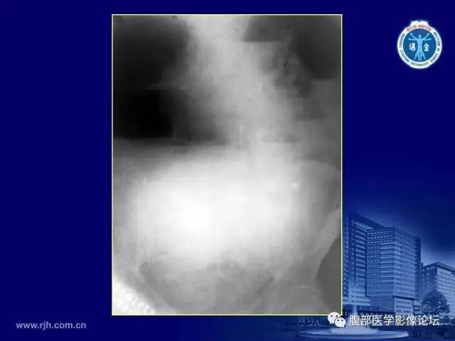 【PPT】急腹症