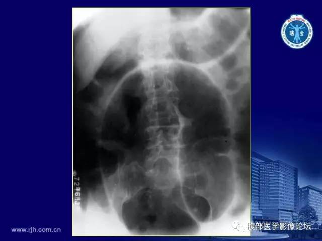 【PPT】急腹症