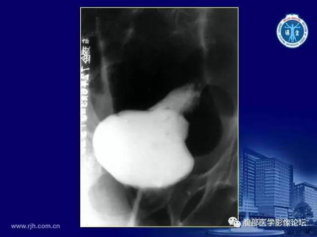 【PPT】急腹症