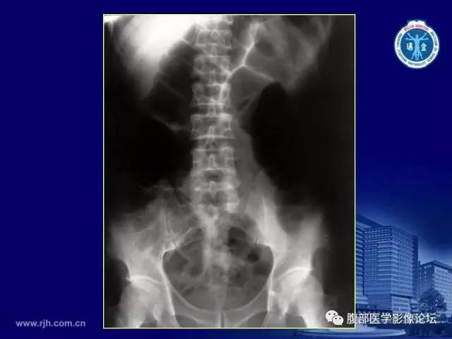 【PPT】急腹症