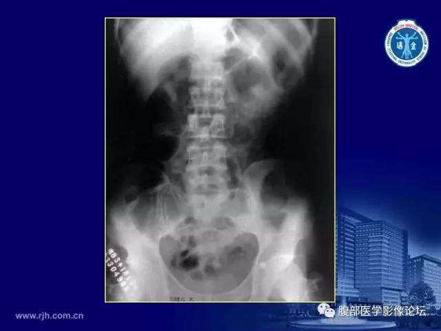 【PPT】急腹症
