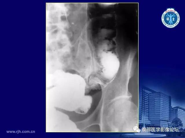 【PPT】急腹症
